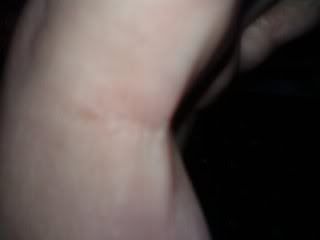 swollen tendons?