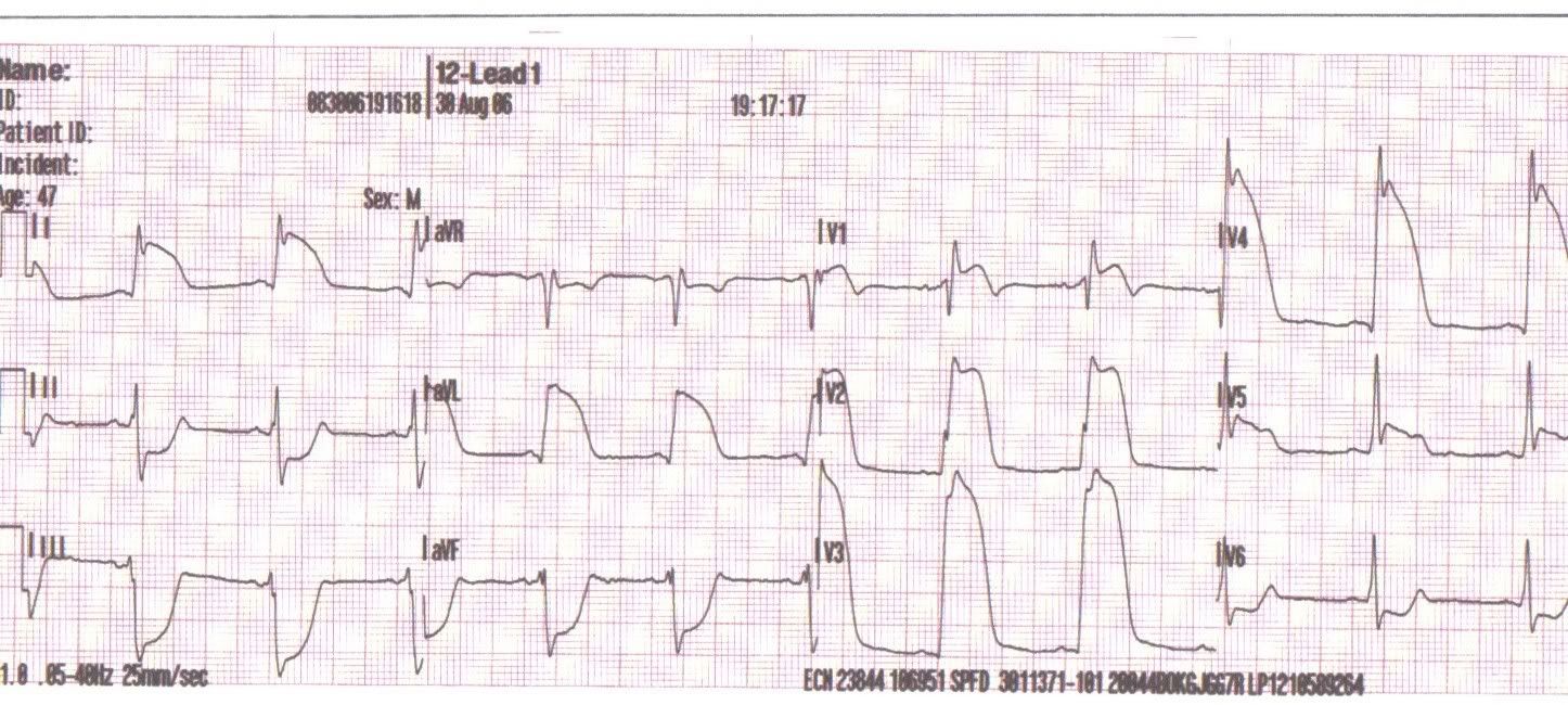 MySTEMI_1.jpg